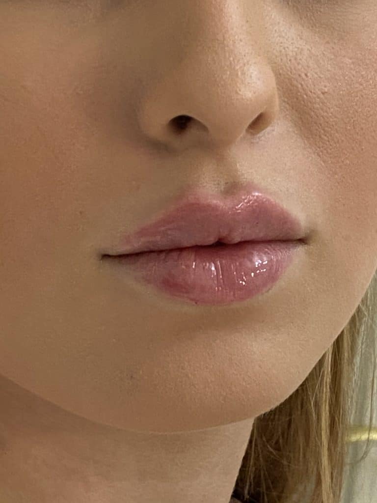 Hyaluronfiller